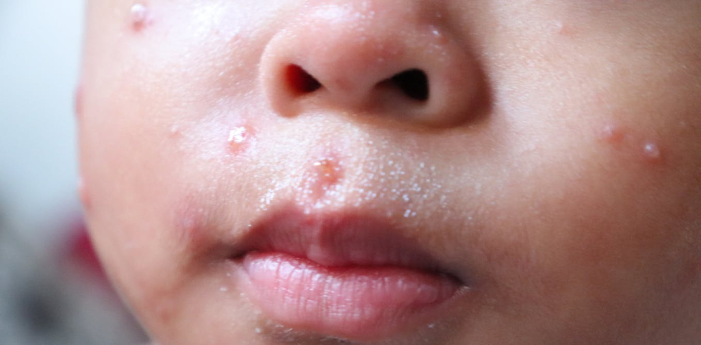 kasus-campak-indonesia-tertinggi-kedua-di-dunia:-efek-mengerikan-hoaks-dan-narasi-antivaksin