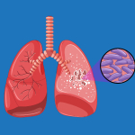 who-merekomendasikan-alat-diagnostik-baru-untuk-mengakhiri-tbc
