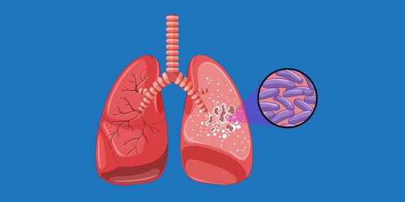 WHO Merekomendasikan Alat Diagnostik Baru untuk Mengakhiri TBC