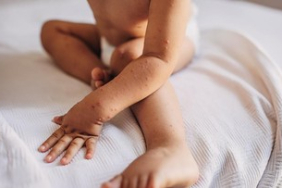 wabah-campak-tewaskan-ratusan-anak-di-negara-ini