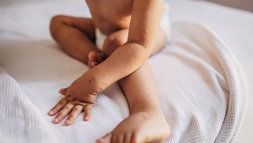 wabah-campak-tewaskan-ratusan-anak-di-negara-ini