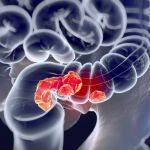 kasus-kanker-usus-usia-muda-naik,-peneliti-temukan-jejak-herbisida-di-dna