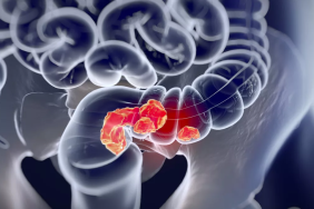 kasus-kanker-usus-usia-muda-naik,-peneliti-temukan-jejak-herbisida-di-dna