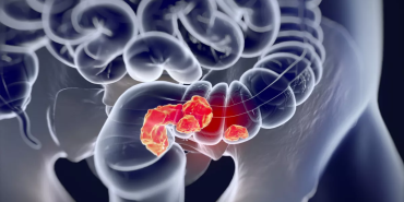kasus-kanker-usus-usia-muda-naik,-peneliti-temukan-jejak-herbisida-di-dna