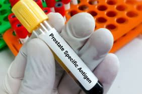 prostate-cancer-overdiagnosis-risk-sharply-rises-after-age-70-–-new-research