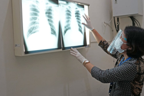 deteksi-tuberkulosis-pakai-ai-cepat-dan-akurat:-mampukah-menjawab-keterbatasan-dokter-di-daerah?