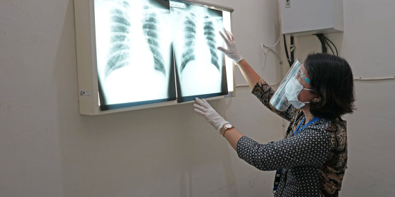 deteksi-tuberkulosis-pakai-ai-cepat-dan-akurat:-mampukah-menjawab-keterbatasan-dokter-di-daerah?