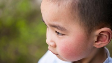 mengenal-penyakit-fifth-disease,-ruam-merah-pada-pipi-anak-atau-sindrom-pipi-ditampar