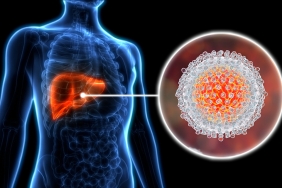 jutaan-orang-terinfeksi-hepatitis,-kenali-gejala-awal-dan-cara-mengobatinya