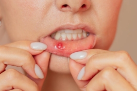 mouth-ulcers:-why-have-i-got-them-and-how-can-i-get-rid-of-them?