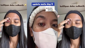 imbas-kelilipan-abu-vulkanik,-perempuan-lampung-ini-alami-pecah-pembuluh-darah-di-mata